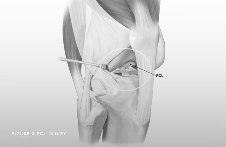 Posterior Cruciate Ligament (PCL) Chicago, IL - Jorge Chahla, MD