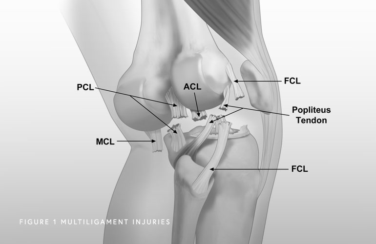 https://www.jorgechahlamd.com/wp-content/uploads/2019/10/Multiligament-Knee-Injuries.jpg