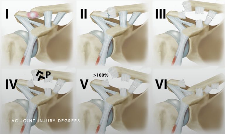 AC Joint Injury Chicago, IL | Dr. Jorge Chahla