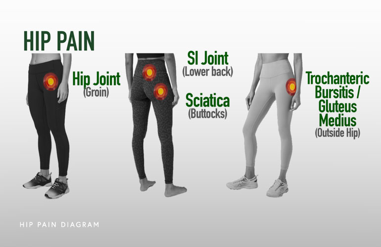 Hip Pain, Hip Arthritis, Hip Bursitis, Hip Impingement