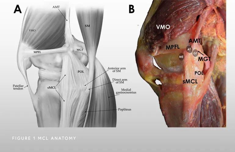 Medial collateral ligament or MCL injury of the knee: what to do