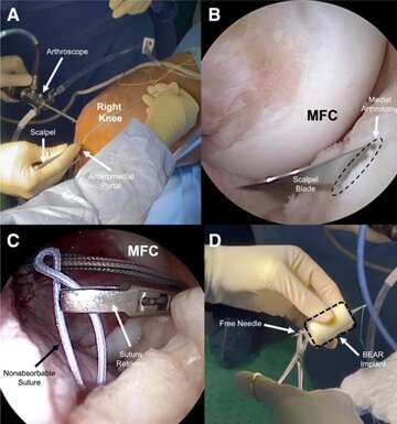 anterior cruciate ligament reconstruction surgery